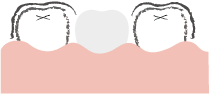 両脇に被せ物をしている歯がある方