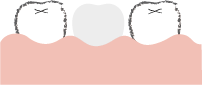 両脇に健全な歯がある方
